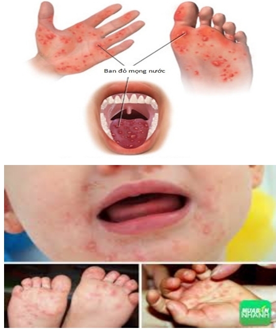 BÀI TUYÊN TRUYỀN VỀ  BỆNH “ TAY- CHÂN – MIỆNG”  CỦA TRƯỜNG MẦM NON KỲ HOA